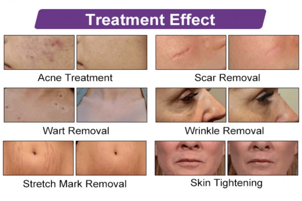 CO2 Fractional Machine Treatment Scope & Effects 2